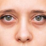 Göz altı morluklarının oluşumunda cilt yapısı, damarlar ve göz çevresi anatomisini gösteren medikal estetik görsel.